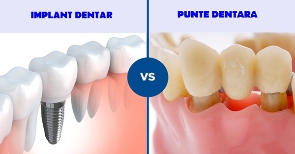 coroana dentara vs implant dentar